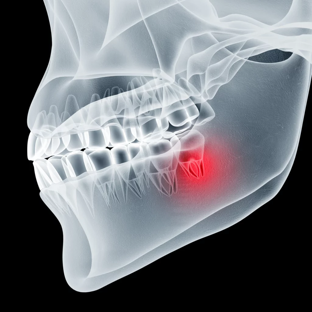 wisdom teeth removal in Lawrenceburg, TN