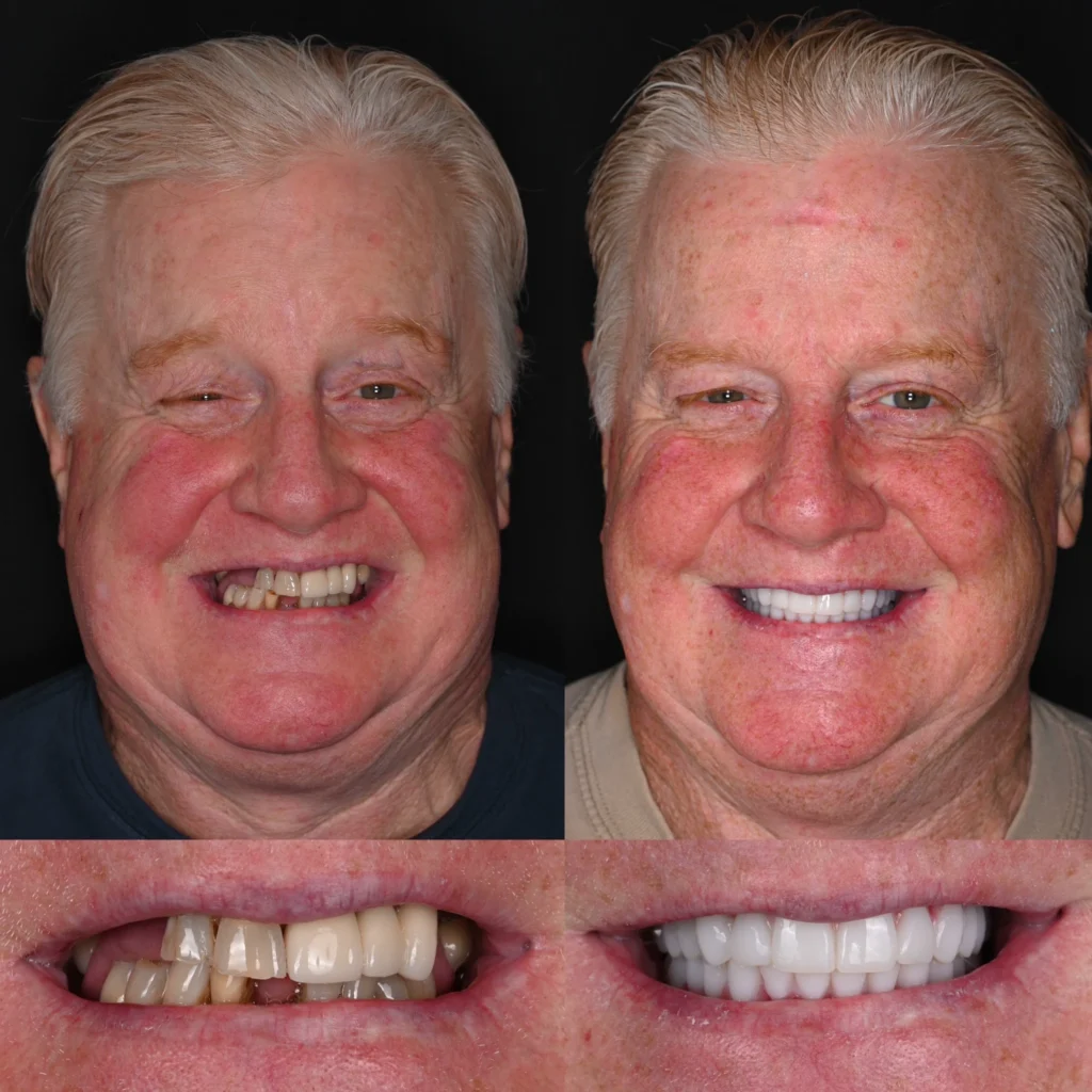 Before and after dental implants in Lawrenceburg, TN at Dentistry of Lawrenceburg