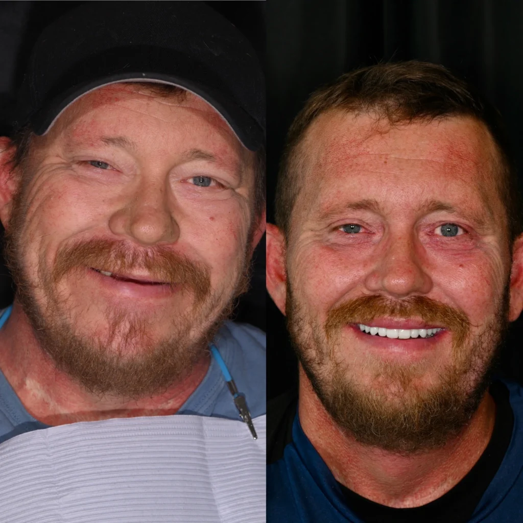 Before and after dental implants in Lawrenceburg, TN at Dentistry of Lawrenceburg