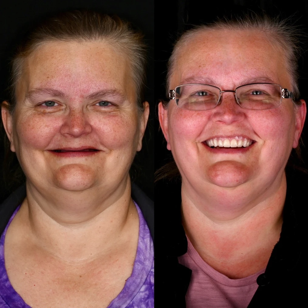 Before and after dental implants in Lawrenceburg, TN at Dentistry of Lawrenceburg