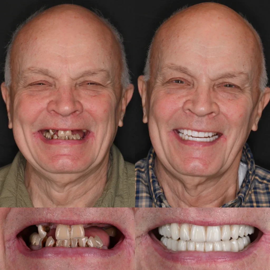 Before and after dental implants in Lawrenceburg, TN at Dentistry of Lawrenceburg
