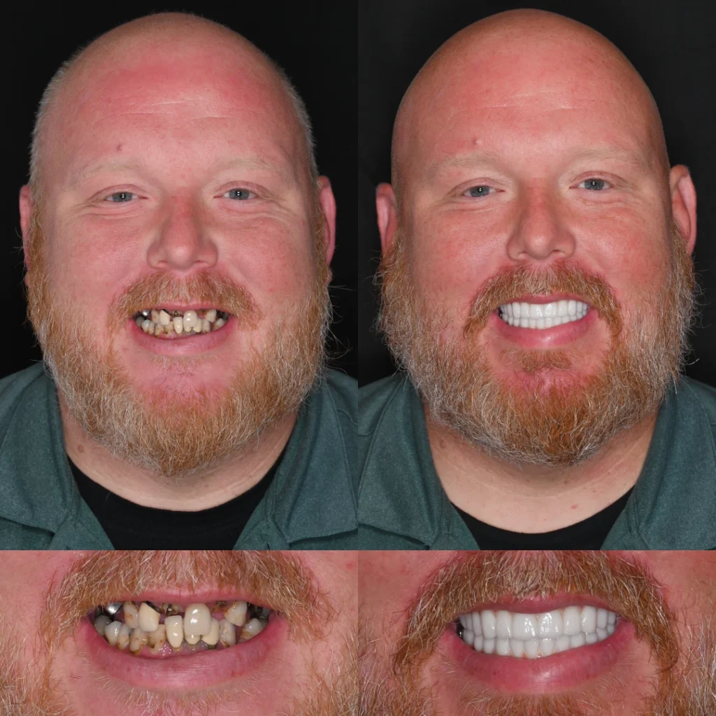 Before and after dental implants in Lawrenceburg, TN at Dentistry of Lawrenceburg