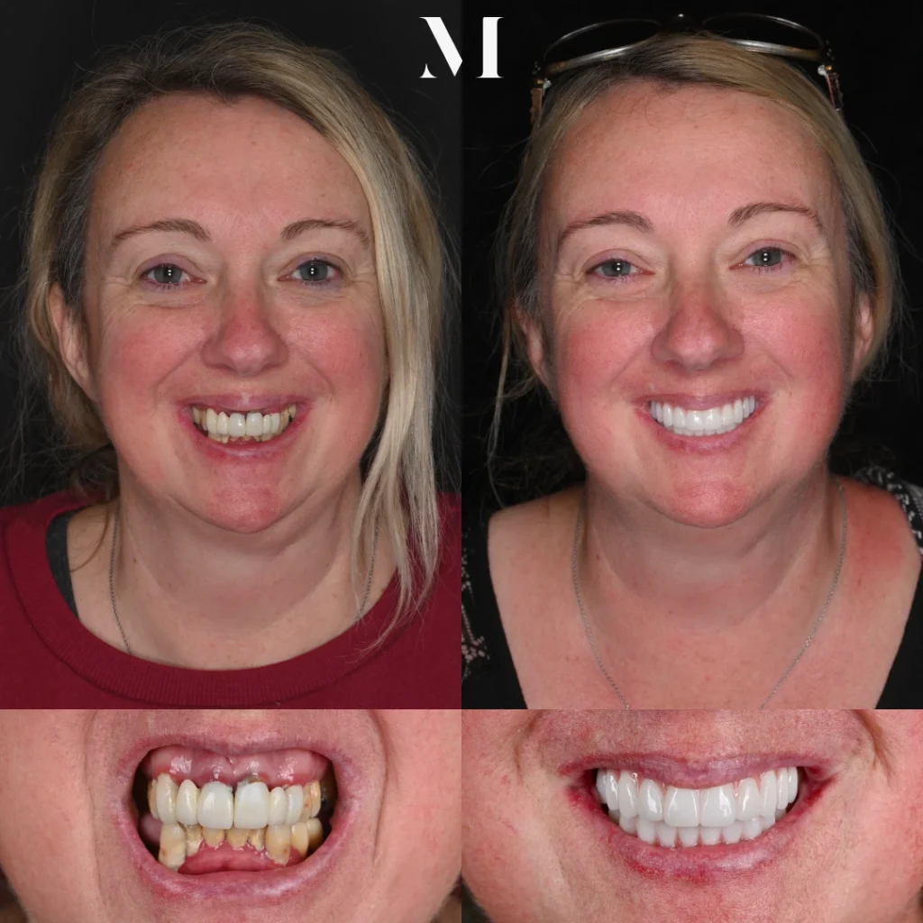 Before and after dental implants in Lawrenceburg, TN at Dentistry of Lawrenceburg